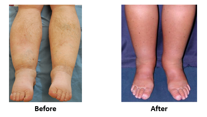 Leg Edema And Leg Swelling Treatment Center For Vascular Medicine